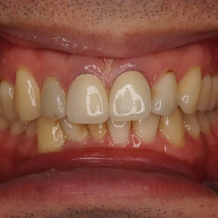 実際のセラミック治療の症例