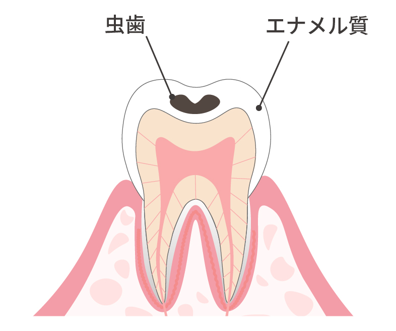 エナメル質の虫歯 上面図