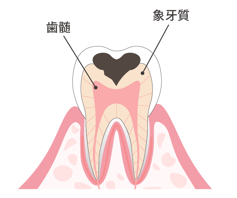 象牙質の虫歯 上面図
