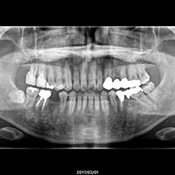 レントゲン写真撮影