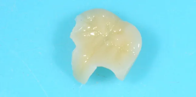 セラミックのインレー