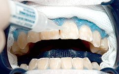 薬剤をと専用の光でホワイトニングを行います