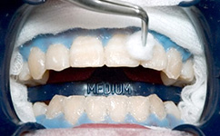 オフィスホワイトニング