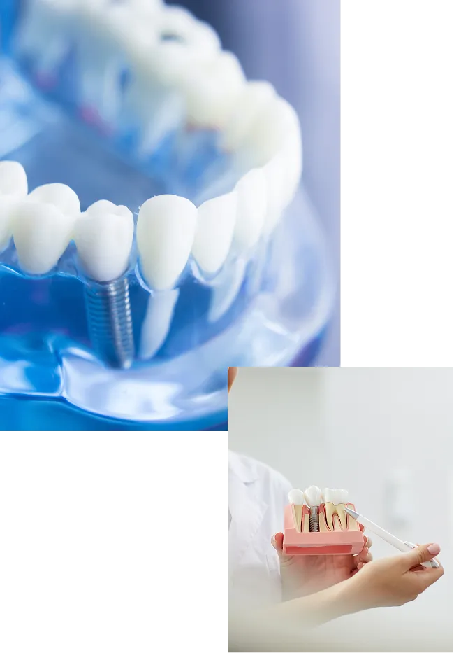 インプラント模型のイメージ