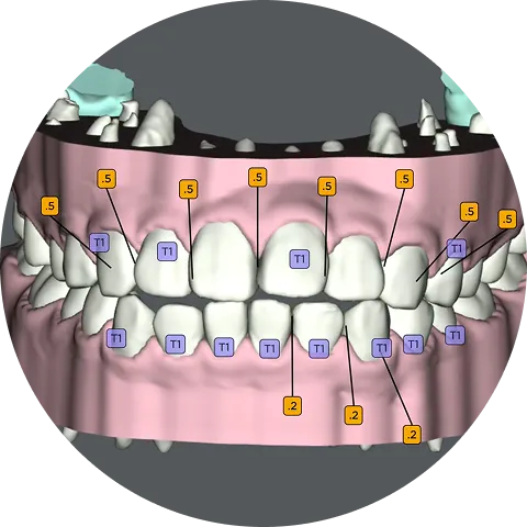 3D治療計画の作成
