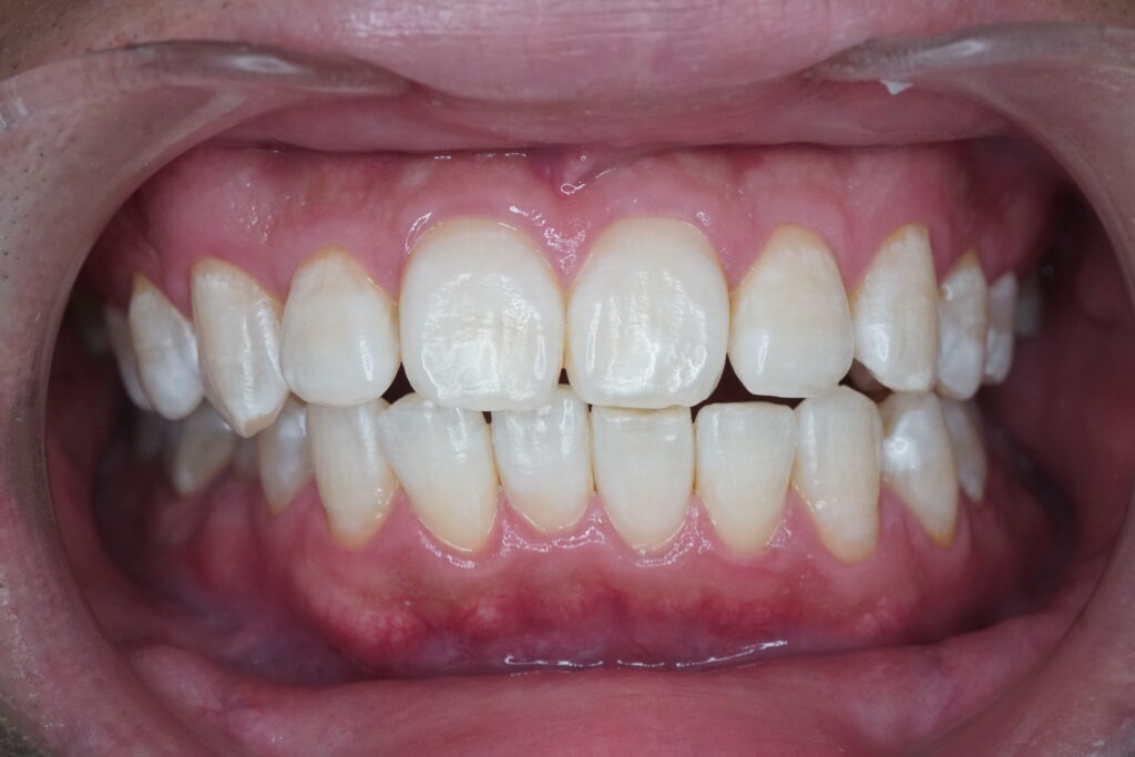ホワイトニングの症例写真