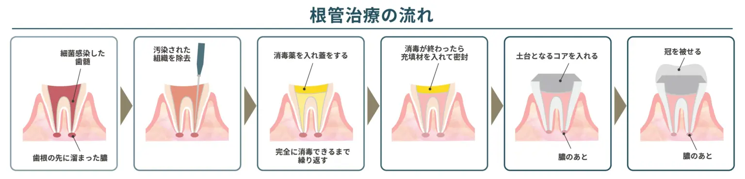 根管治療の流れ