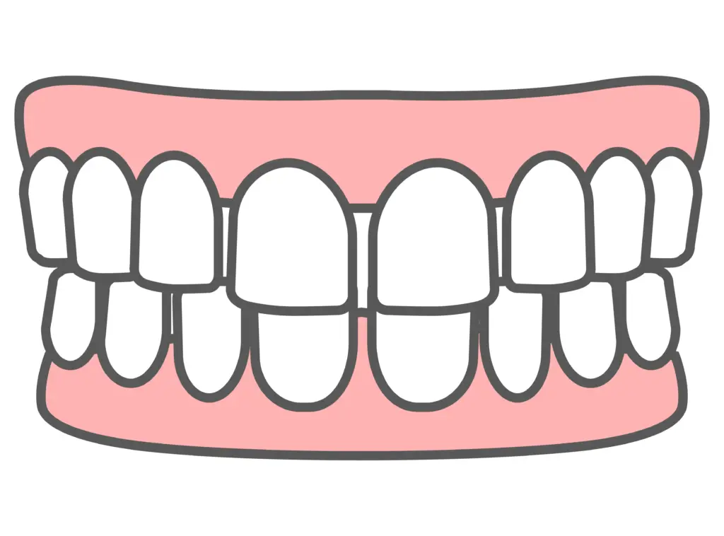 すきっ歯（空隙歯列）