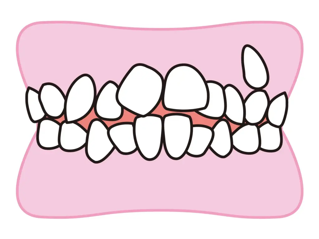 ガタガタな歯並び（叢生）