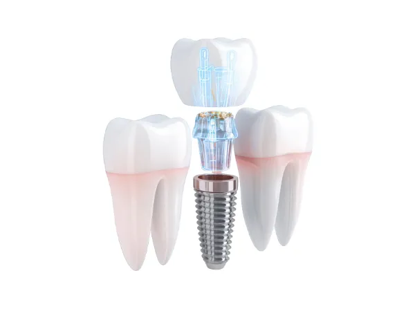 セラミックの治療メニュー