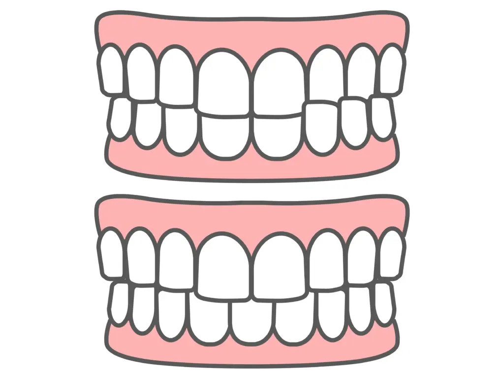 交叉咬合・顎変形症