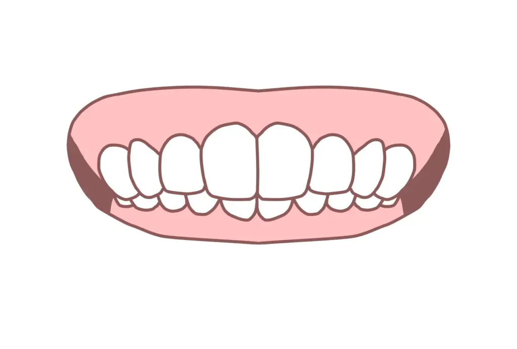 深い噛み合わせ（過蓋咬合）