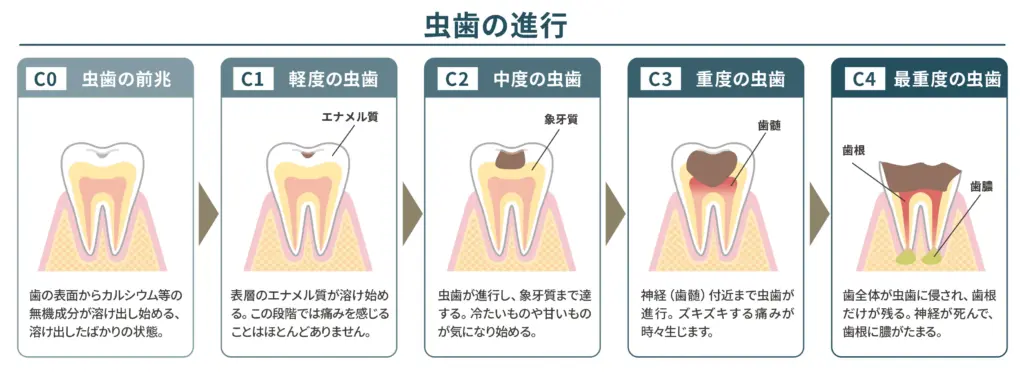 虫歯の進行と虫歯の段階別治療法